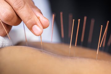 Acupuncture